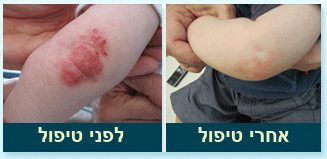 תמונה לפני ואחרי טיפול